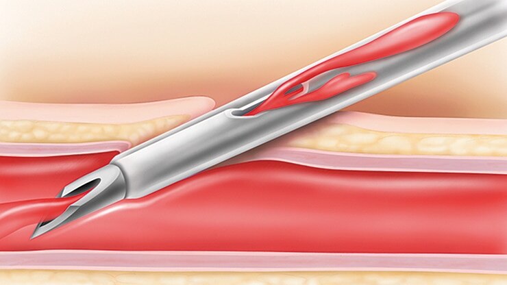 BD Instaflash™ needle technology