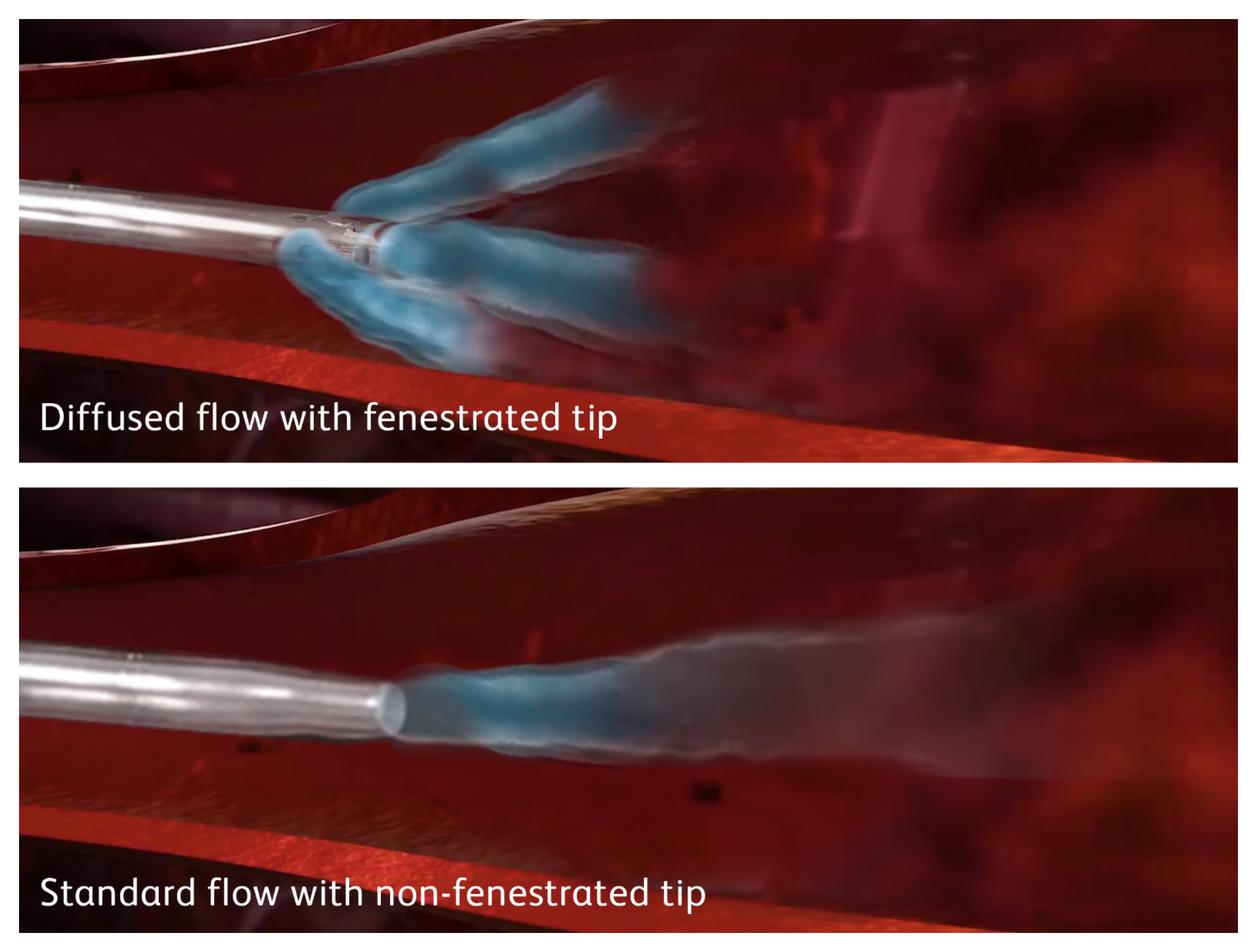 <p> </p>
<p>Nexiva Diffusics™ Catheter System for cardiac CTs</p>
