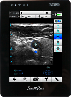 Visualize and measure catheter size relative to the vessel