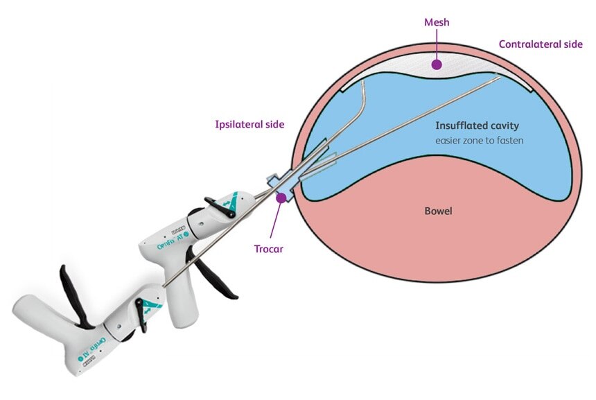 Full mesh access from one side of the patient